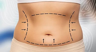 Liposuction ile Vücut Şekillendirmede Gerçekçi Beklentiler